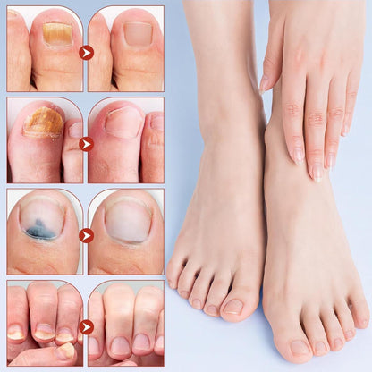 Fungal Nail Repair Patches - 21 PCS Overnight Antifungal Treatment for Toenails & Fingernails ✅Trusted Seller